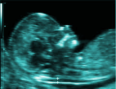 feto con translucencia